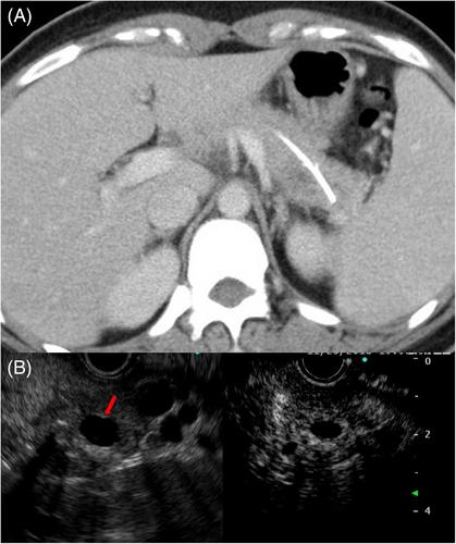 Pancreatic mucinous cystadenoma mimicking pancreatic pseudocyst