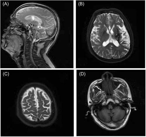 Contralateral C7 nerve transfer in the treatment of central hemiplegia after stroke under general anesthesia: A case report