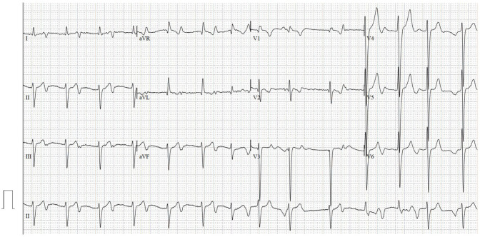 Heterotaxy Syndrome with Polysplenia, Fused Adrenal Glands, and Diabetes Mellitus.