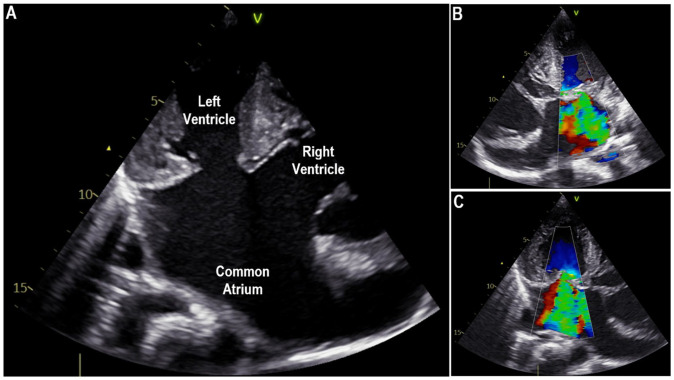 Heterotaxy Syndrome with Polysplenia, Fused Adrenal Glands, and Diabetes Mellitus.