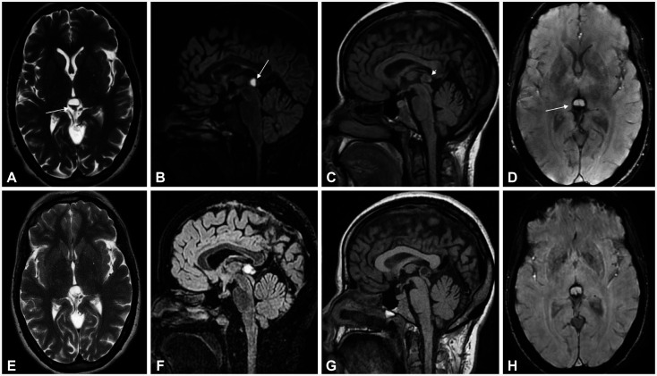 Pineal Apoplexy Presenting With Recurrent Migraine-Like Headache and Transitory Neurological Dysfunction During Pregnancy.