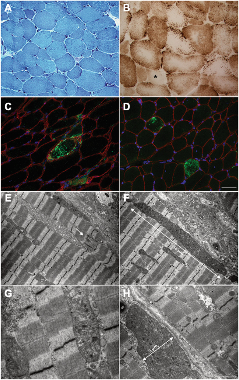 Megaconial congenital muscular dystrophy due to novel CHKB variants: a case report and literature review.