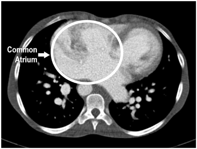 Heterotaxy Syndrome with Polysplenia, Fused Adrenal Glands, and Diabetes Mellitus.