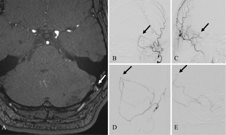 Dural Arteriovenous Fistula Mimicking a Brain Tumor on Methionine-positron Emission Tomography: A Case Report.