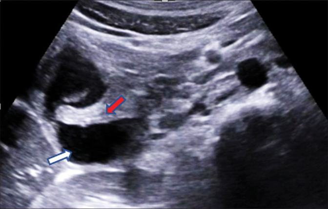 Groove pancreatitis: A unique case of focal pancreatitis.