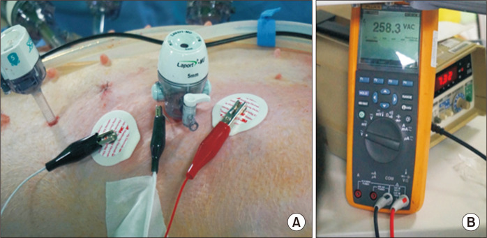 Capacitive coupling leading to electrical skin burn injury during laparoscopic surgery.