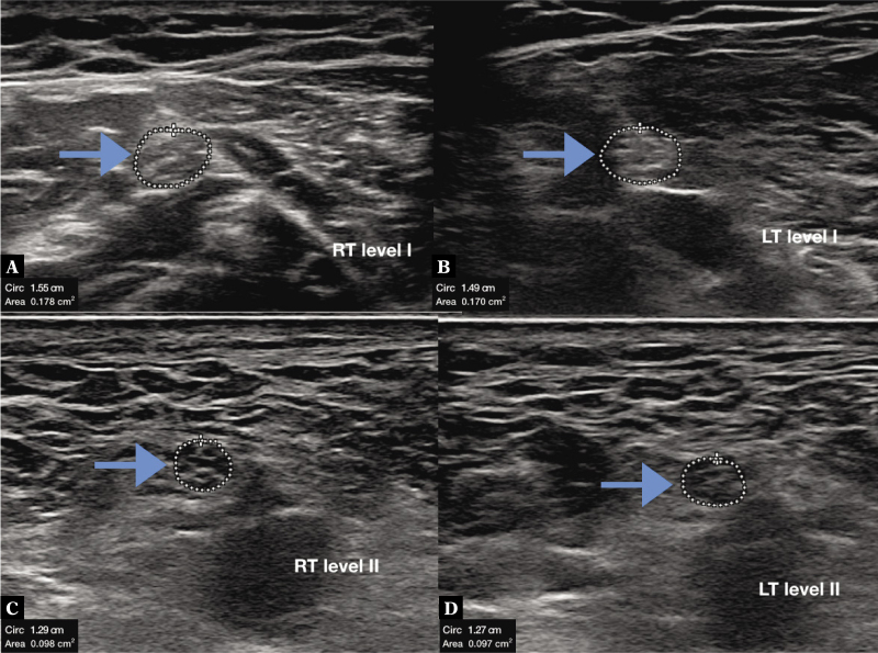 Reference Values for the Cross Sectional Area of Normal Tibial Nerve on High-resolution Ultrasonography.