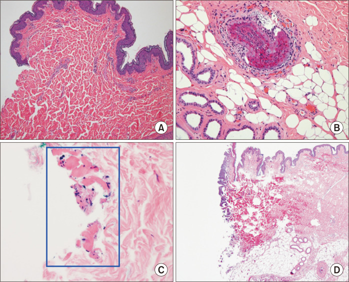 Capacitive coupling leading to electrical skin burn injury during laparoscopic surgery.