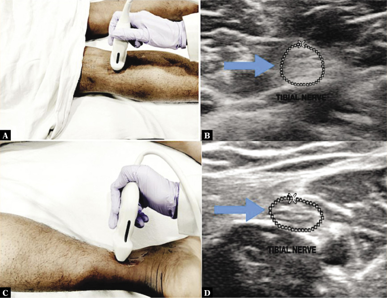 Reference Values for the Cross Sectional Area of Normal Tibial Nerve on High-resolution Ultrasonography.