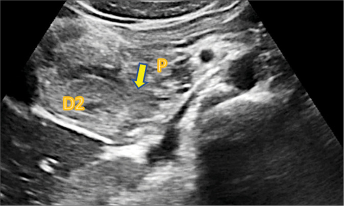 Groove pancreatitis: A unique case of focal pancreatitis.