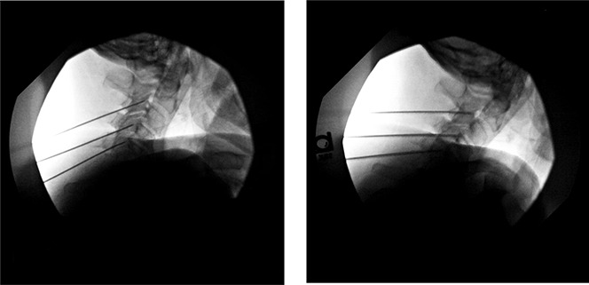 Dropped head syndrome: report of a rare complication after multilevel bilateral cervical radiofrequency neurotomy.