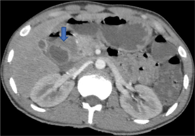 Groove pancreatitis: A unique case of focal pancreatitis.