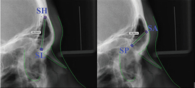 The relationship between frontal sinus dimensions and skeletal malocclusion.