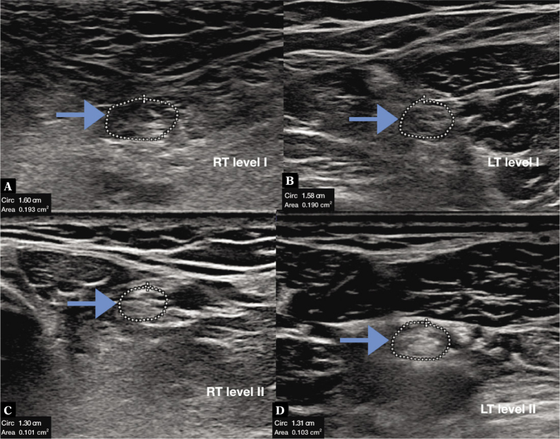 Reference Values for the Cross Sectional Area of Normal Tibial Nerve on High-resolution Ultrasonography.