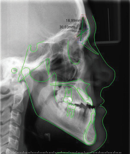 The relationship between frontal sinus dimensions and skeletal malocclusion.