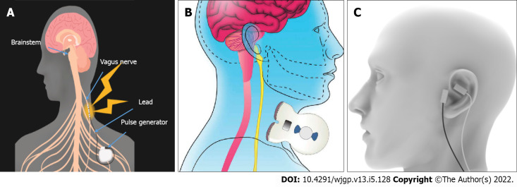 Electrical neuromodulation therapy for inflammatory bowel disease.