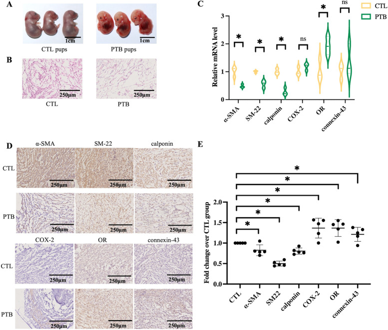Metabonomics profile analysis in inflammation-induced preterm birth and the potential role of metabolites in regulating premature cervical ripening.