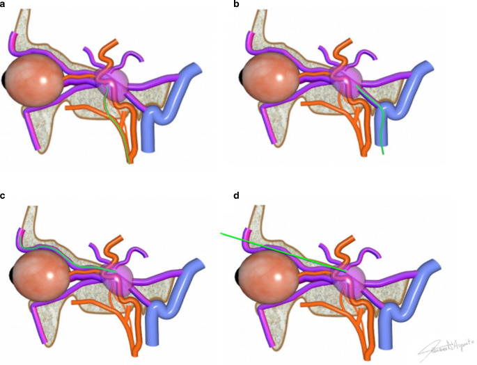 Endovascular Treatment of Cavernous Sinus Dural Arteriovenous Fistulas. Institutional Series, Systematic Review and Meta-Analysis.