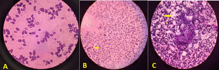 Malignant infantile osteopetrosis in a 3-year-old Yemeni child: a case report.