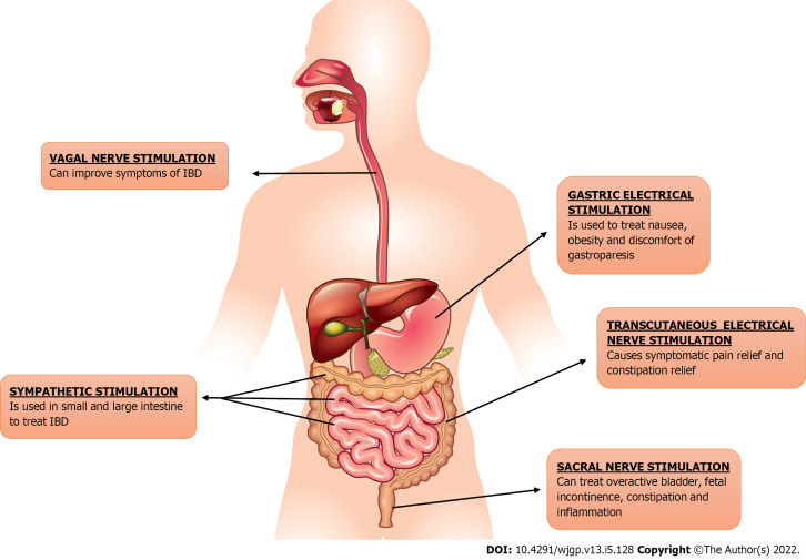 Electrical neuromodulation therapy for inflammatory bowel disease.
