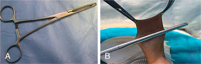 Comparison of a modified Mogen clamp and classic dorsal slit circumcision under local anesthesia: A clinical study.