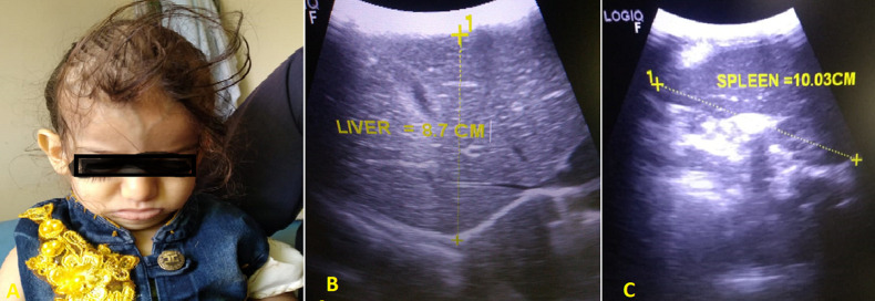 Malignant infantile osteopetrosis in a 3-year-old Yemeni child: a case report.