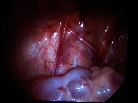 In Which Patients and Why Is Laparoscopy Helpful for the Impalpable Testis?