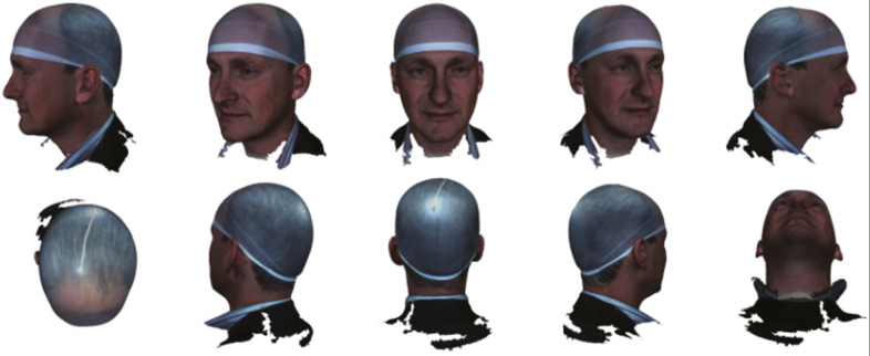 Applications of 3D Photography in Craniofacial Surgery.