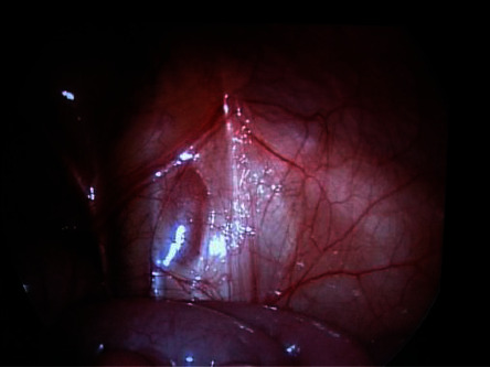 In Which Patients and Why Is Laparoscopy Helpful for the Impalpable Testis?