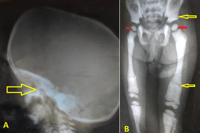 Malignant infantile osteopetrosis in a 3-year-old Yemeni child: a case report.