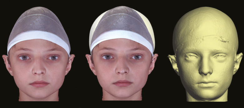 Applications of 3D Photography in Craniofacial Surgery.