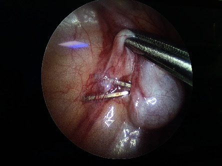 In Which Patients and Why Is Laparoscopy Helpful for the Impalpable Testis?