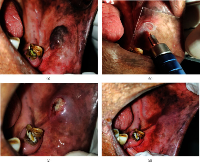 Comparative Evaluation of Efficacy and Safety of the Diode Laser (980 nm) and Sclerotherapy in the Treatment of Oral Vascular Malformations.