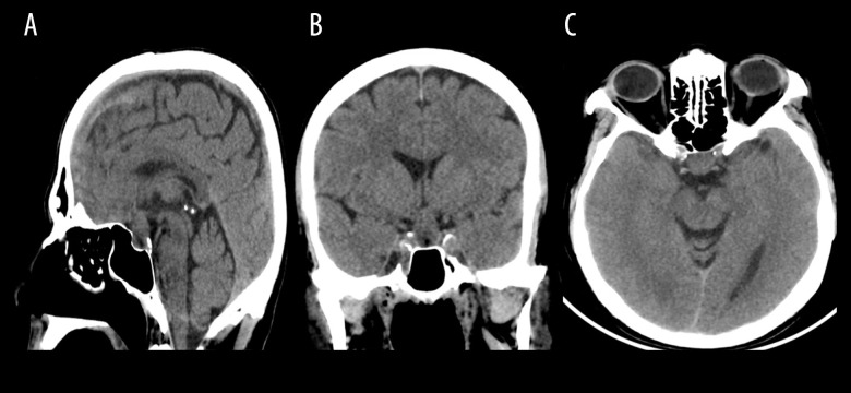 A Pituitary Abscess Caused by Morganella morganii: A Case Report.