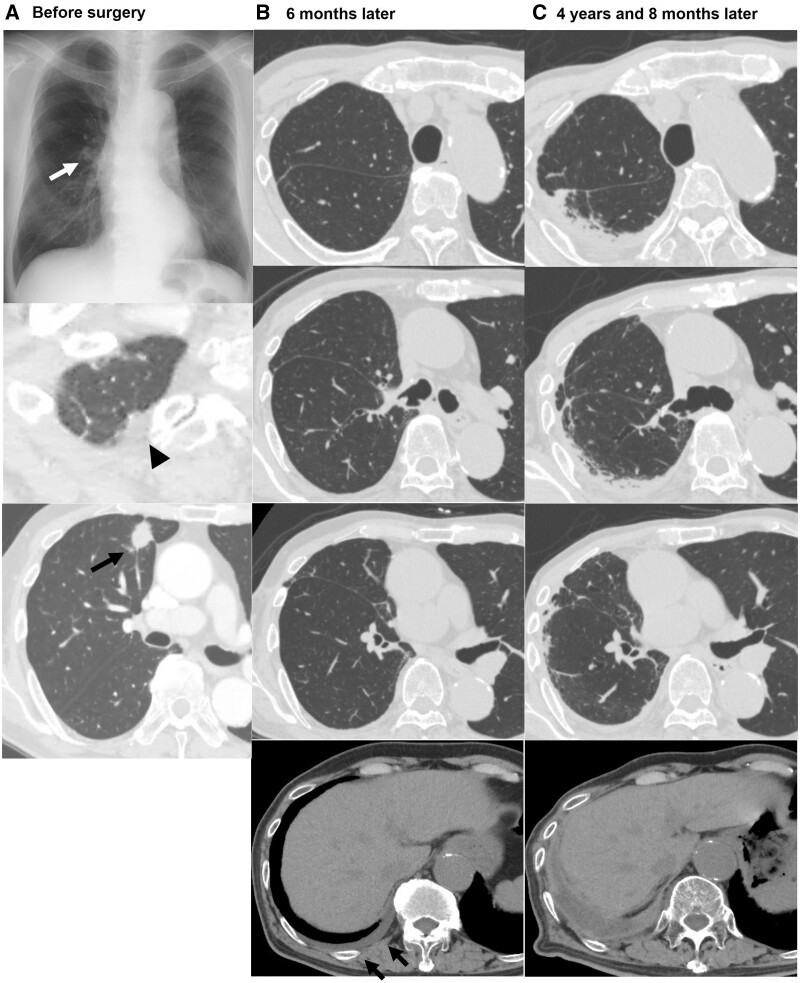 Radiological unilateral pleuroparenchymal fibroelastosis as a notable late complication after lung cancer surgery: incidence and perioperative associated factors.