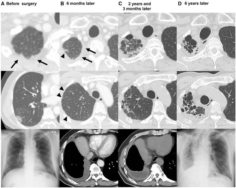 Radiological unilateral pleuroparenchymal fibroelastosis as a notable late complication after lung cancer surgery: incidence and perioperative associated factors.