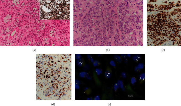 Diffuse-Type Tenosynovial Giant Cell Tumour Involving Bone Masquerading as Langerhans Cell Histiocytosis.