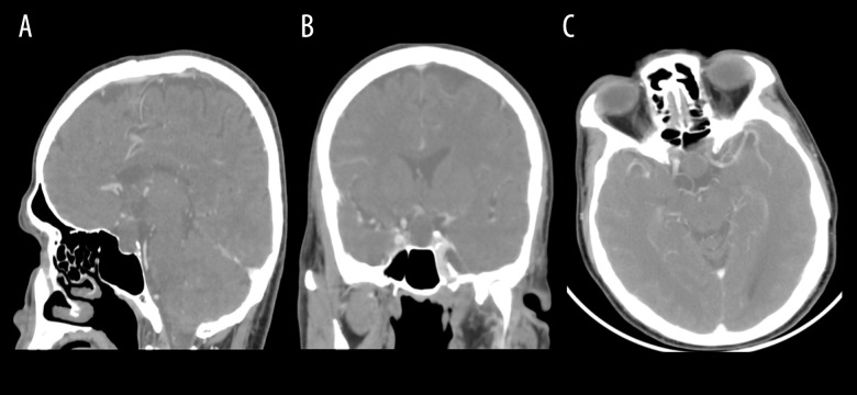 A Pituitary Abscess Caused by Morganella morganii: A Case Report.