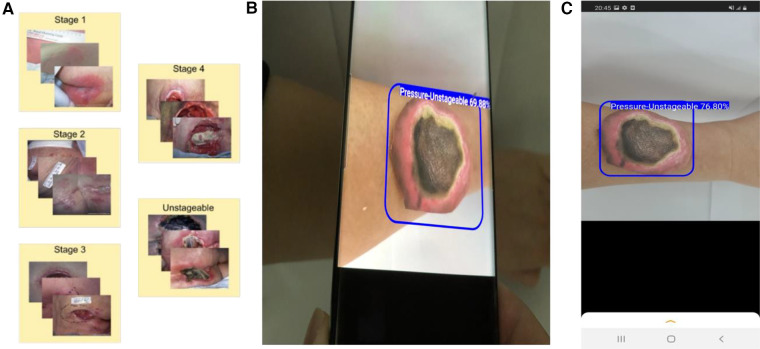 An artificial intelligence-enabled smartphone app for real-time pressure injury assessment.