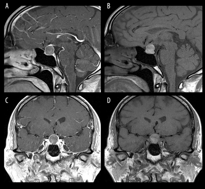 A Pituitary Abscess Caused by Morganella morganii: A Case Report.