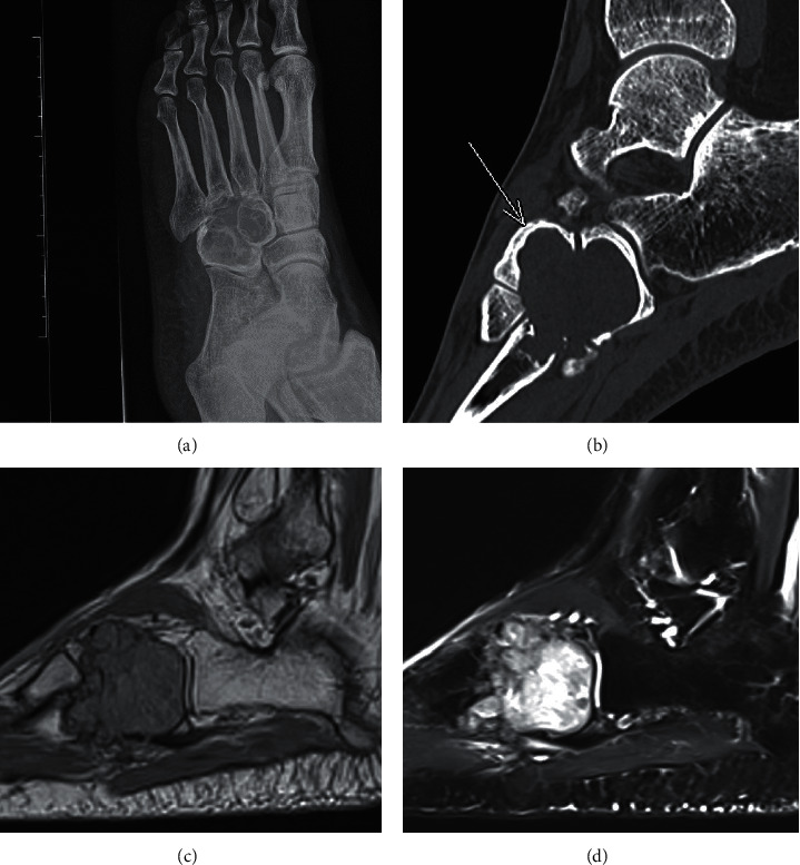 Diffuse-Type Tenosynovial Giant Cell Tumour Involving Bone Masquerading as Langerhans Cell Histiocytosis.