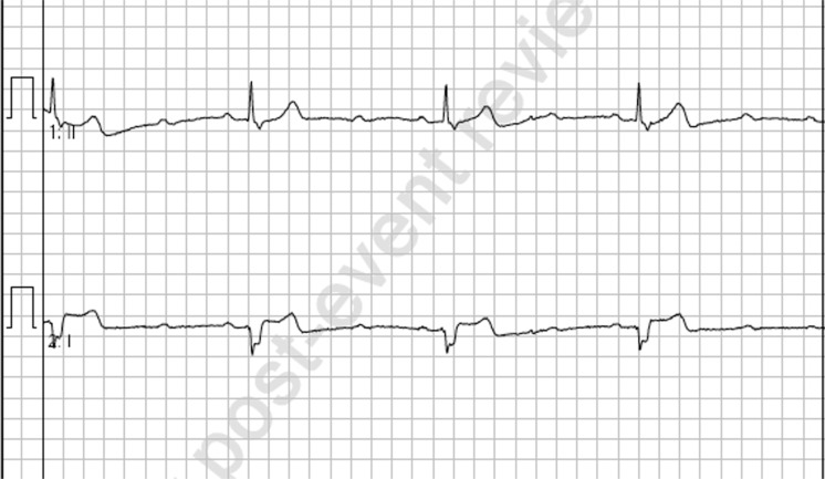 Paradoxical worsening of bradycardia following atropine administration.