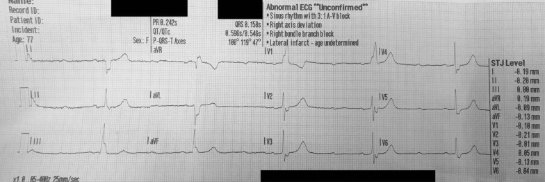 Paradoxical worsening of bradycardia following atropine administration.