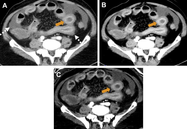 Coronavirus Disease in the Abdomen