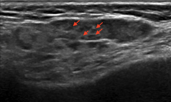 Salivary Gland Ultrasound in Primary Sjögren's Syndrome: Current and Future Perspectives.