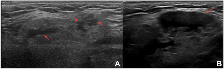 Salivary Gland Ultrasound in Primary Sjögren's Syndrome: Current and Future Perspectives.