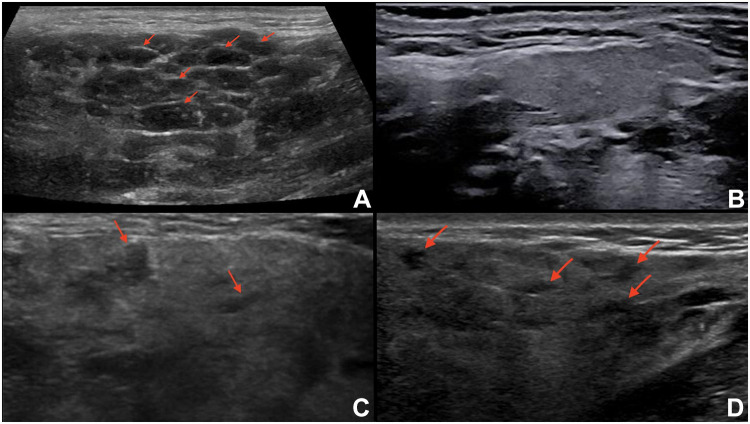 Salivary Gland Ultrasound in Primary Sjögren's Syndrome: Current and Future Perspectives.