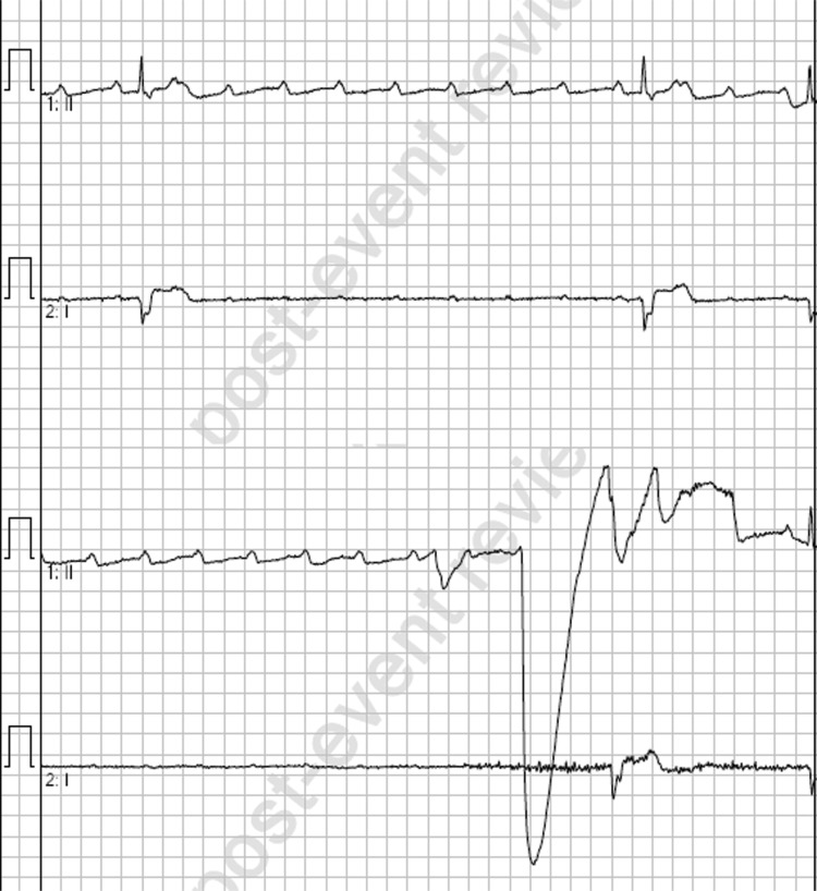 Paradoxical worsening of bradycardia following atropine administration.