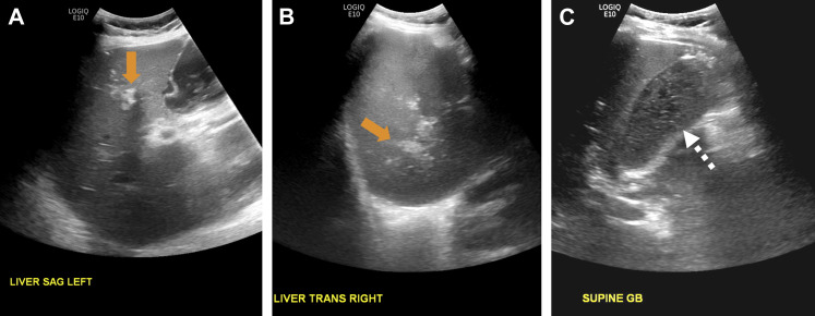 Coronavirus Disease in the Abdomen