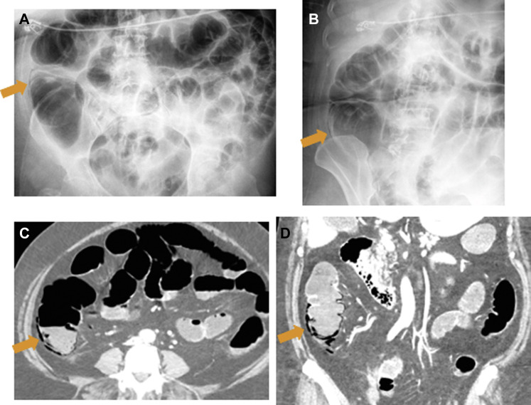 Coronavirus Disease in the Abdomen